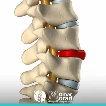 عمليات التدخل المحدود