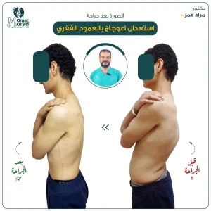 عملية تركيب دعامات العمود الفقري - دكتور مراد عمر