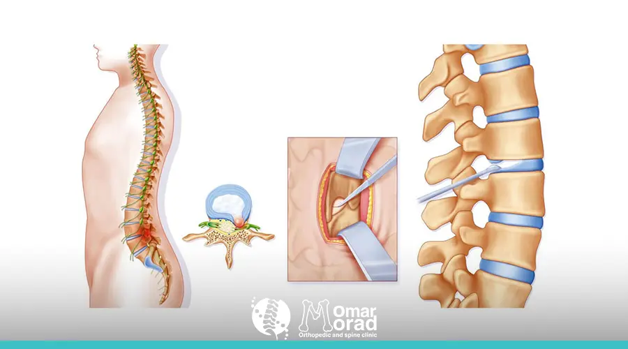 ما هو ديسك الرقبة؟ الأعراض والأسباب وطرق العلاج